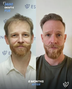 FUE Hair Transplant 3600 Grafts 6 Months Before&After FUE Hair Transplant 3600 Grafts 6 Months Before&After