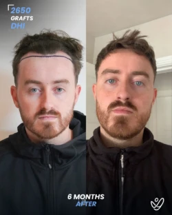 DHI Hair Transplant 2650 Grafts 6 Months Before&After DHI Hair Transplant 2650 Grafts 6 Months Before&After