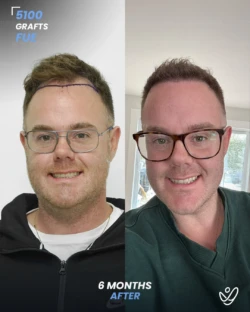 FUE Hair Transplant 5100 Grafts 6 Months Before&After FUE Hair Transplant 5100 Grafts 6 Months Before&After