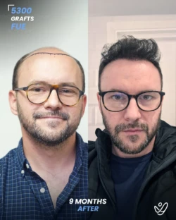 FUE Hair Transplant 5300 Grafts 9 Months Before&After FUE Hair Transplant 5300 Grafts 9 Months Before&After