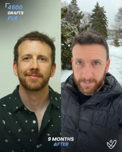 FUE Hair Transplant 4500 Grafts 9 Months Before&After FUE Hair Transplant 4500 Grafts 9 Months Before&After