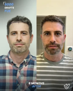 FUE Hair Transplant 5000 Grafts 6 Months Before&After FUE Hair Transplant 5000 Grafts 6 Months Before&After