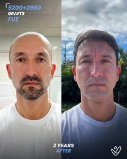 FUE Hair Transplant 5200+2950 Grafts 24 Months Before&After FUE Hair Transplant 5200+2950 Grafts 24 Months Before&After
