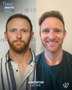 DHI Hair Transplant 3800 Grafts 8 Months Before&After DHI Hair Transplant 3800 Grafts 8 Months Before&After